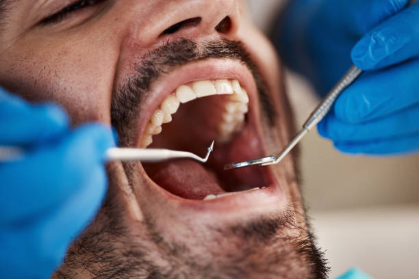 Best Emergency Wisdom Teeth Removal in Rock Creek, MN