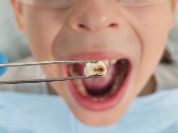 Best Emergency Tooth Extraction in Rock Creek, MN